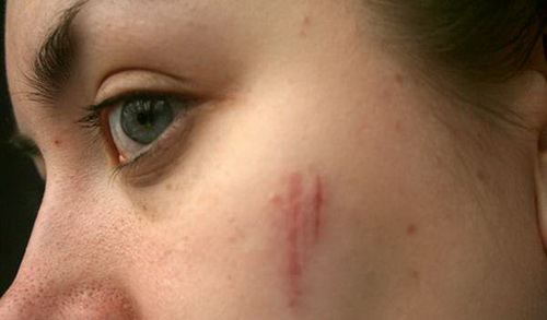 Inilah 13 Cara Alami Menghilangkan Bekas Luka